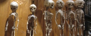 Sideshow Freak Mutter Museum    medical oddities Skulls